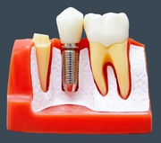Best Dental Implants by Top Local Dentists in San Diego